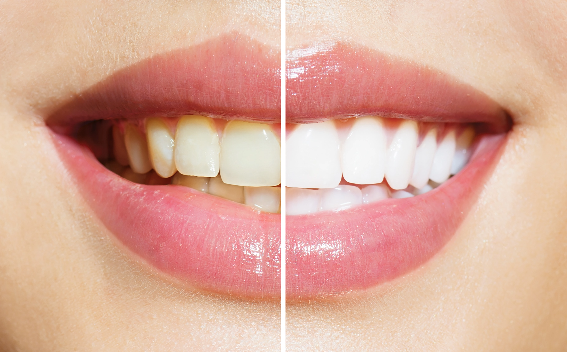 teeth-whitening-dazzling-results